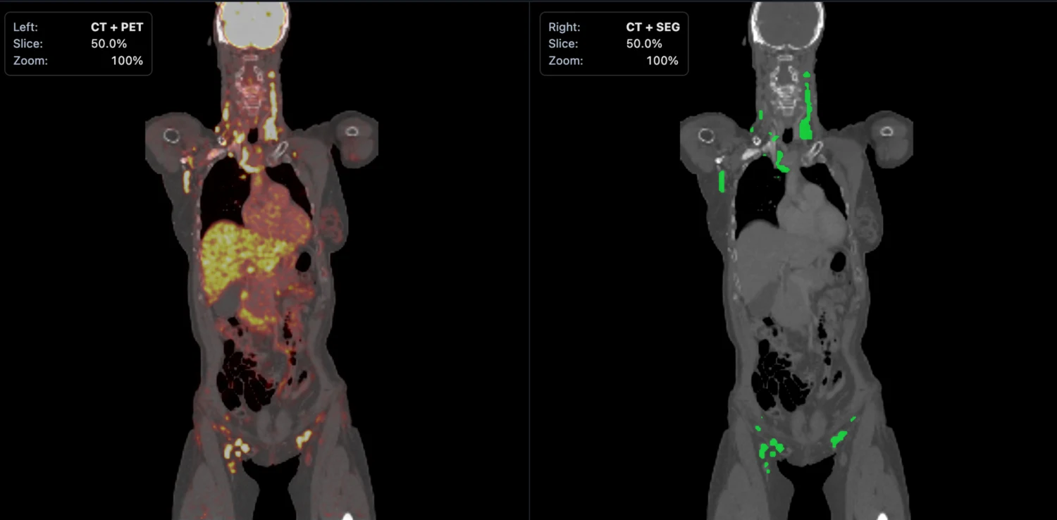 Side-by-side PET/CT input and segmentation mask output from the interactive sample case