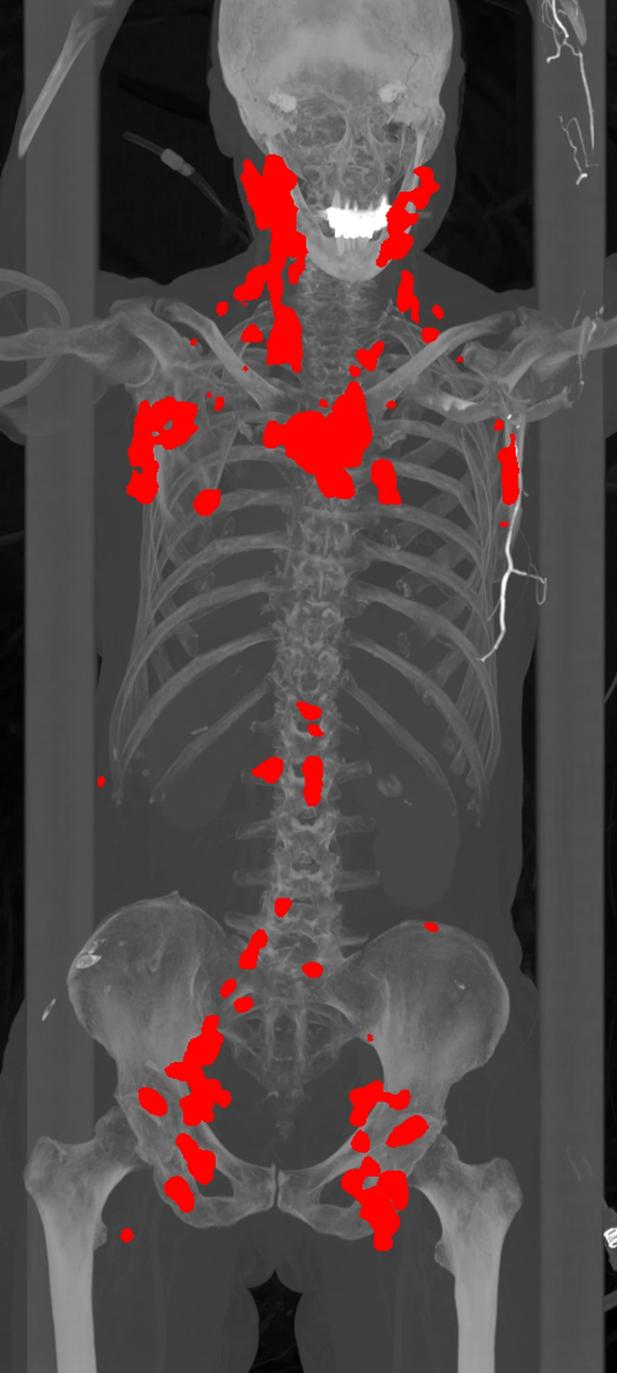 Whole-body segmentation mask from a DLBCL PET/CT case
