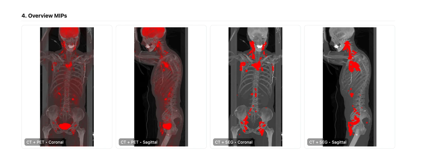 Overview MIP images from the sample PET/CT report